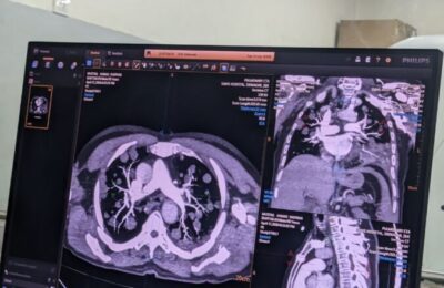 Quels Organes Voit-on sur un Scanner Thoracique : Exploration Complète