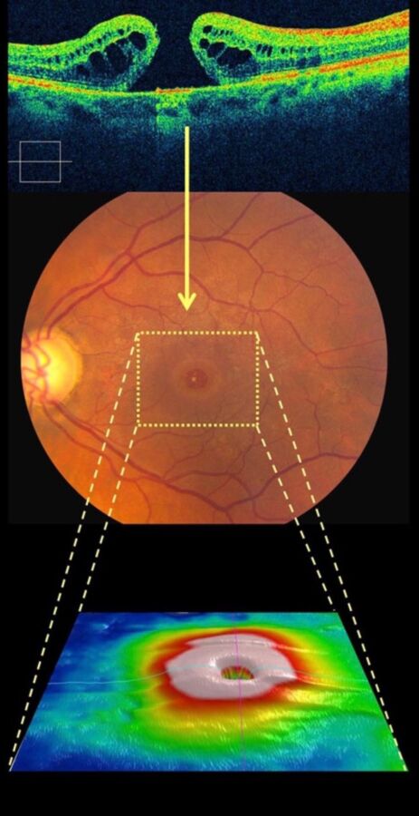 Conseils pour IRM oculaire