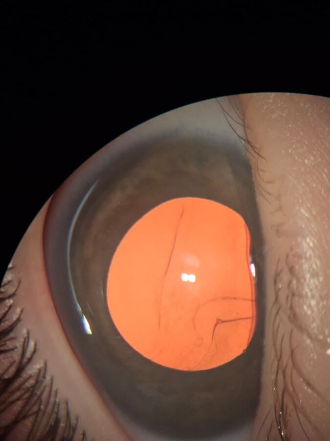 Étapes IRM yeux expliquées