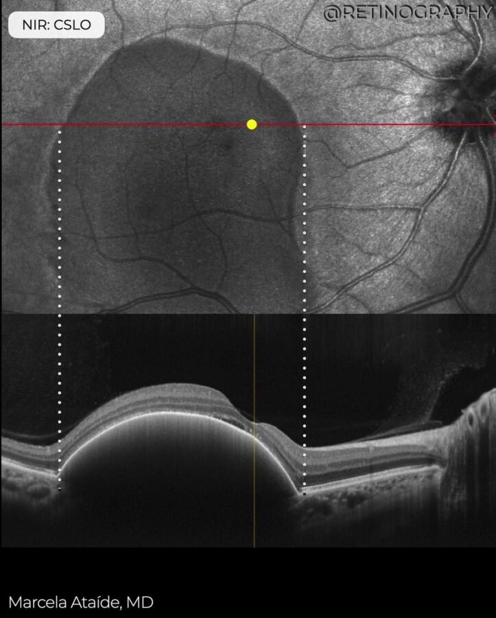 Conseils pour IRM oculaire