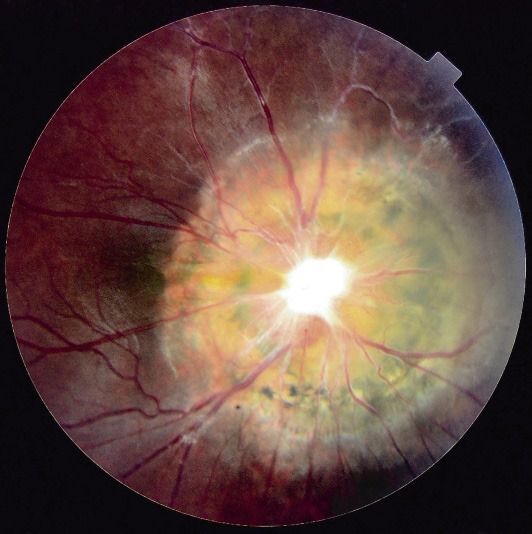 Procédure IRM des yeux