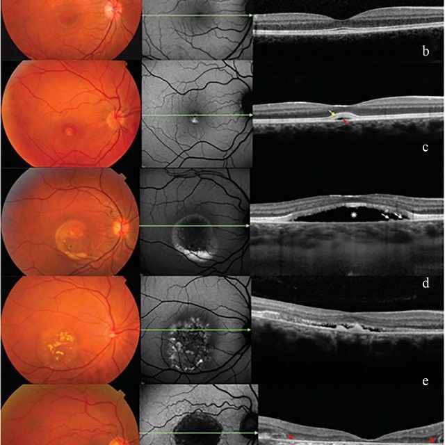 Étapes IRM yeux expliquées