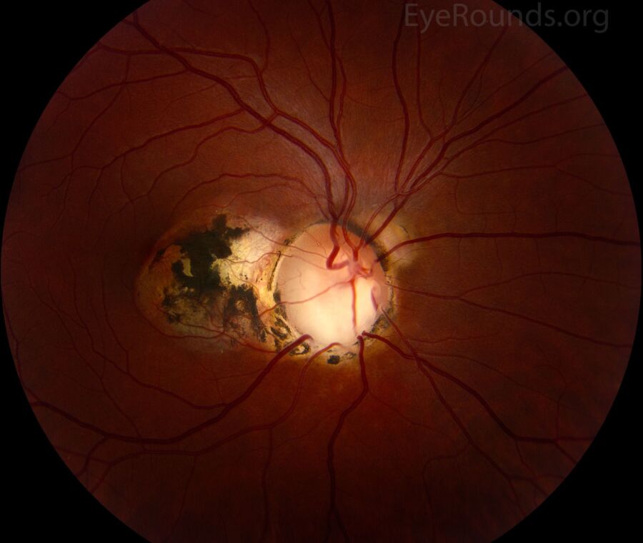 Procédure IRM des yeux