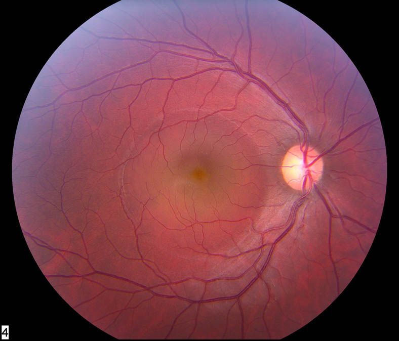 Conseils pour IRM oculaire
