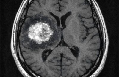 Taches blanches au cerveau : Que révèle l&rsquo;IRM ?