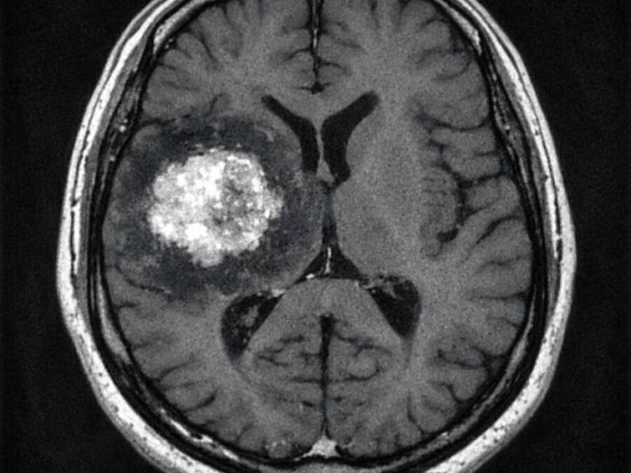 Taches blanches au cerveau : Que révèle l&rsquo;IRM ?