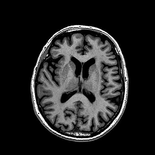 IRM cerveau taches blanches