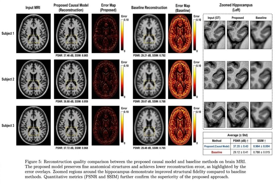 IRM cerveau taches blanches