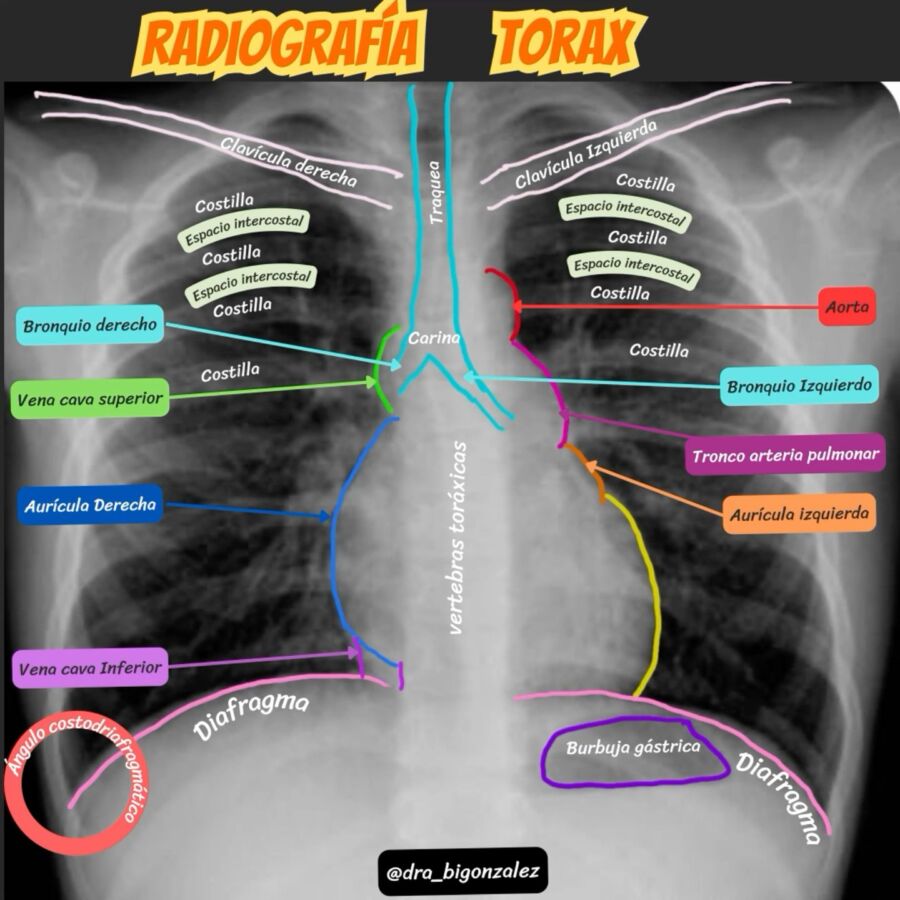 Radiographie thoracique standard