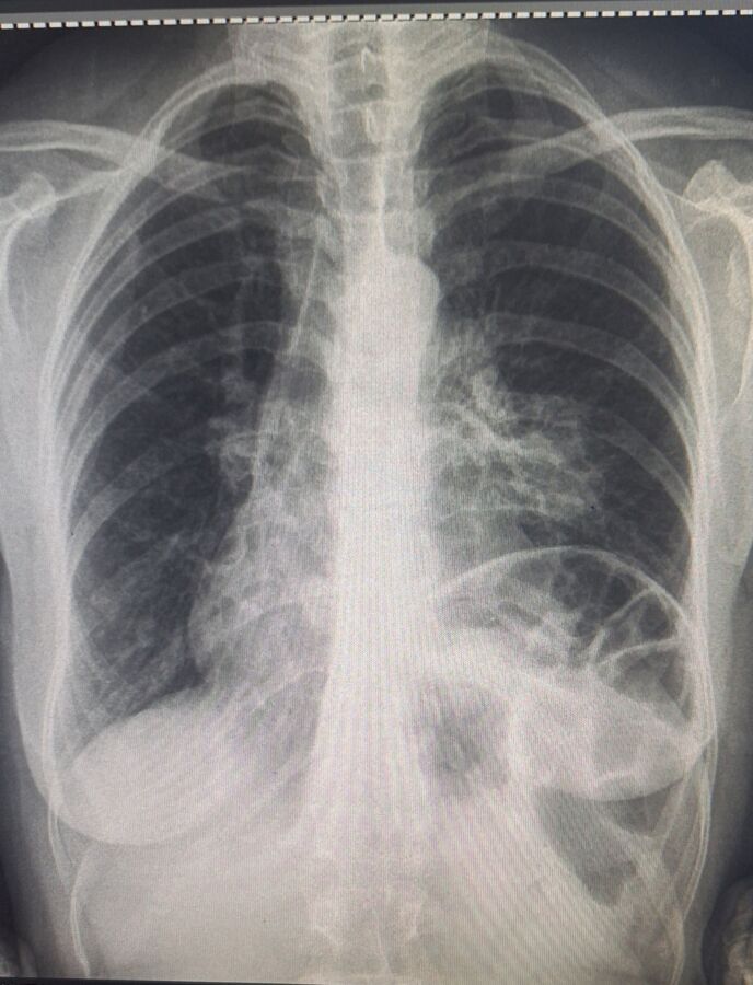 Résultat normal radio thorax
