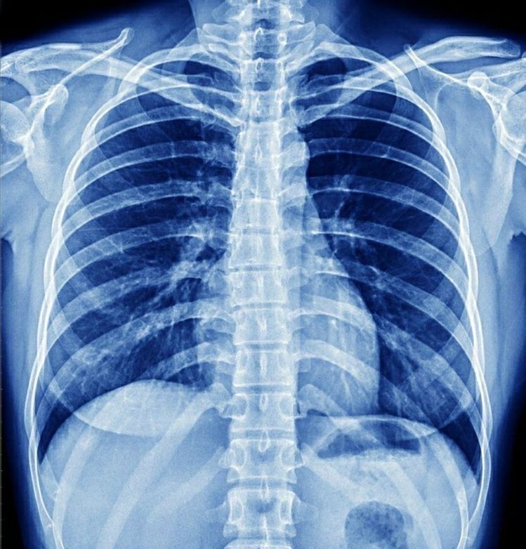 Radiographie thoracique standard