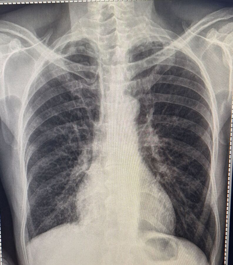 Résultat normal radio thorax