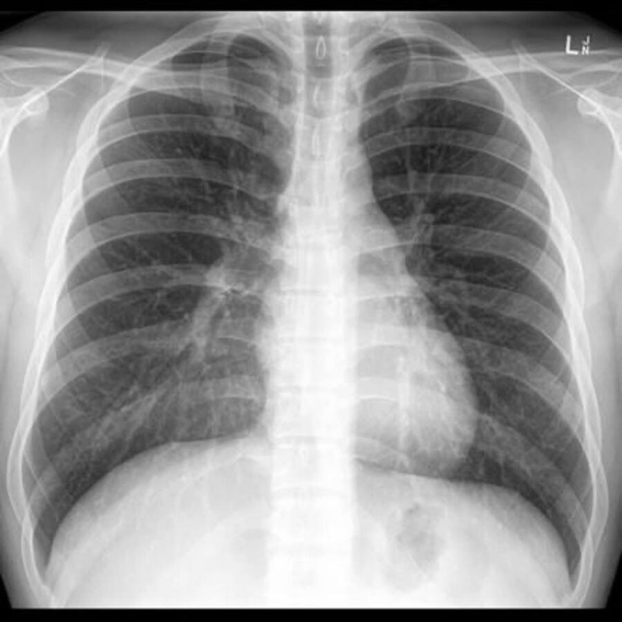 Radiographie thoracique standard