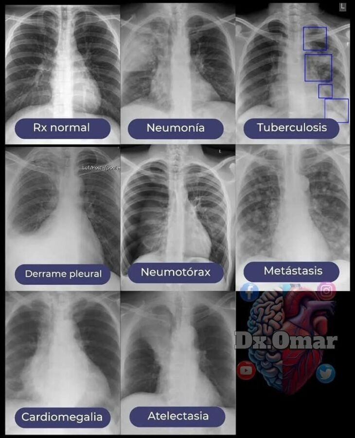 Résultat normal radio thorax