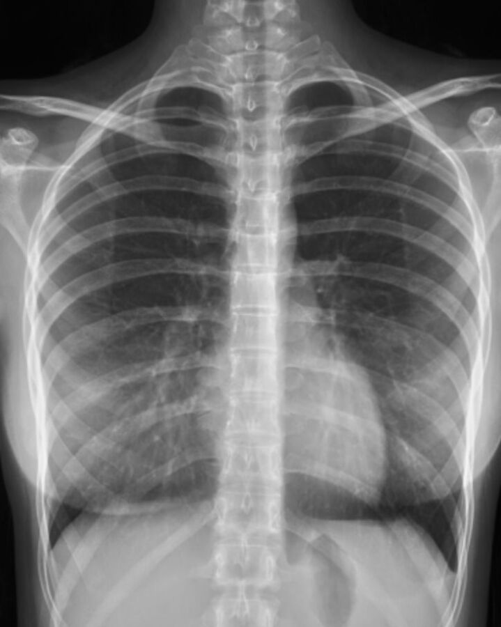Radiographie thoracique standard