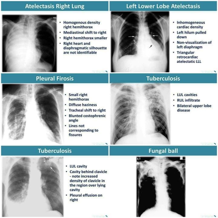 Résultat normal radio thorax