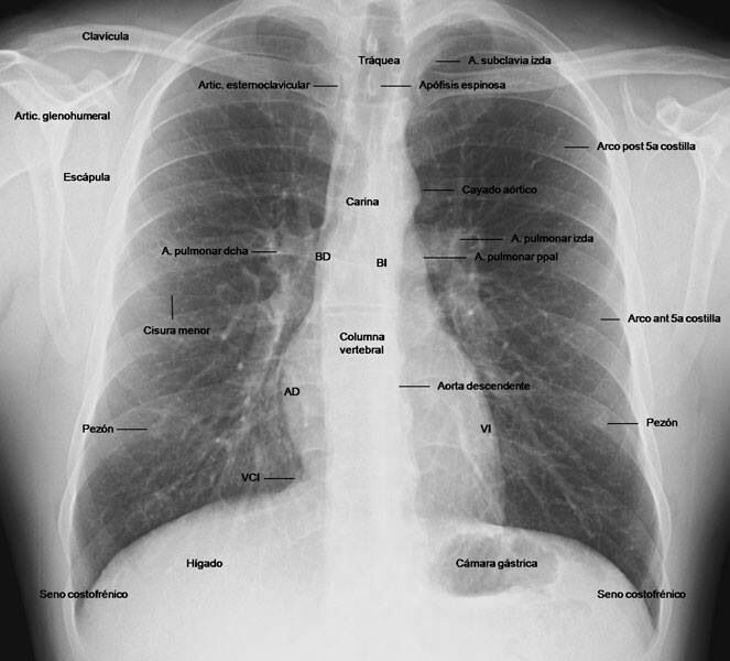 Radiographie thoracique standard