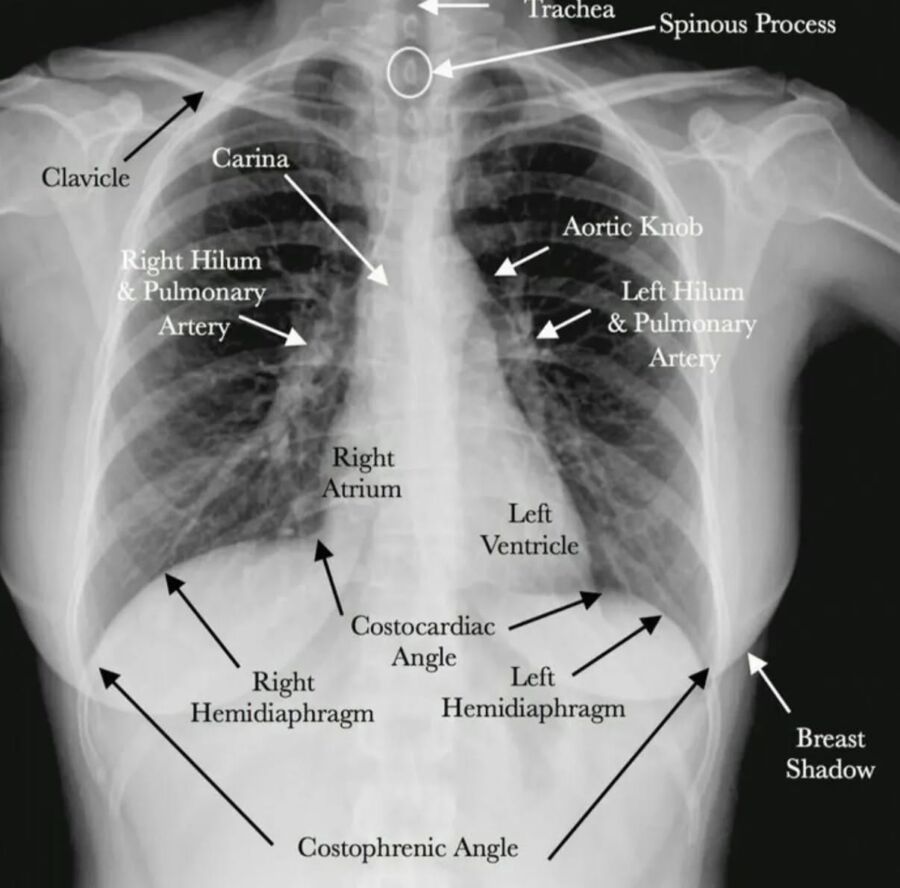 Résultat normal radio thorax