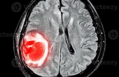 Substance blanche du cerveau : Que montre l&rsquo;IRM ?