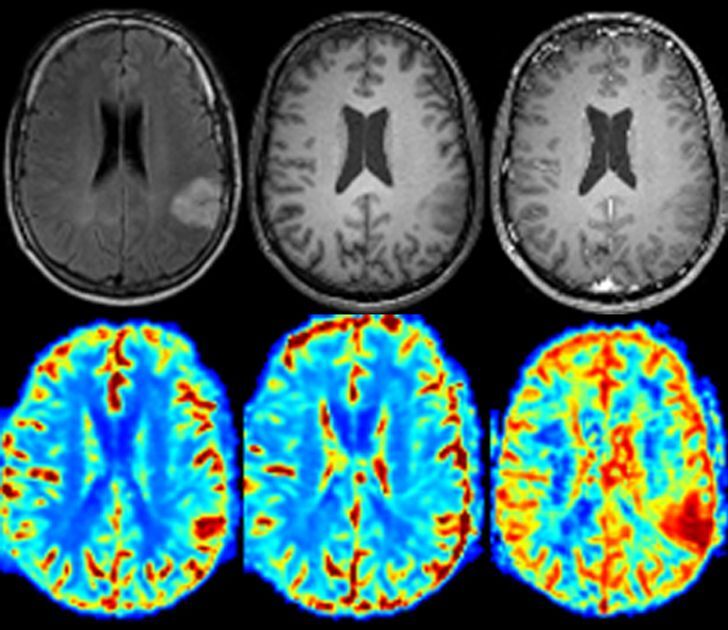 Analyse IRM cerveau