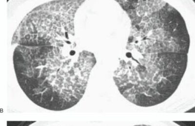 Comment se Passe un Scanner Thoracique : Guide du Déroulement