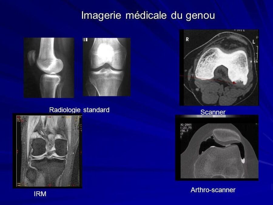 IRM genou sans contraste