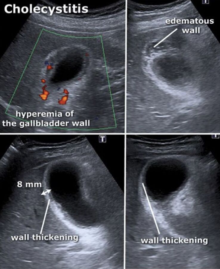 Échographie abdominale et jeûne