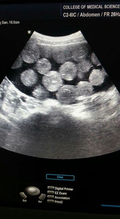 Préparation échographie abdominale